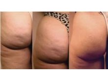 Cellulite & Body sculpting