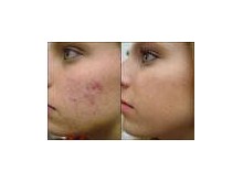 Phototherapy for Acne, Scars, Dark Spots