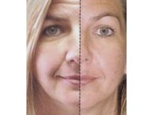 Elasticn & Collagen Infusion therapy